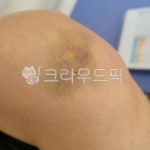 무릎, 무릎멍, 멍, 멍자국, 피멍, 사진,이미지,일러스트,캘리그라피 - 모먼트111작가 크라우드픽 - 저작권 걱정 없는 상업용 이미지