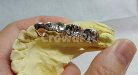 치과, 크라운, 골드, 브릿지, dentist, 사진,이미지,일러스트,캘리그라피 - SeeOn작가 크라우드픽 - 저작권 걱정 없는 상업용 이미지