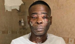 Ex-boxing champion shares horrific picture after a pressure cooker exploded in his face | Boxing | Sport | Express.co.uk Ex... 