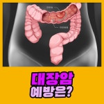 대장암을 예방하기 위해서는 : 건강검진정보