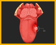 단순 입병이 아닌 설암, 조기 치료 필요해 : 건강검진정보