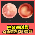 만성 중이염 수술로 완치 가능해 : 건강검진정보