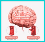 대한민국 3대 사망 원인 질환인 뇌졸중 전조증상 : 건강검진정보