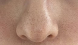 혐오주의) 코랑 볼 모공이랑 블랙헤드 너무 심한데 - 인스티즈(instiz) 일상 카테고리 혐오주의) 코랑 볼 모공이랑 블랙헤드 너무 심한데