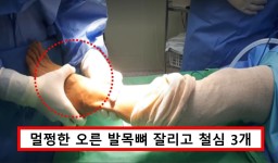 실수로 왼발 대신 오른발 수술.. 서울 유명 정형외과에서 발생한 의료 사고 수준에 모두 경악했다 < 사회 < 기사본문 - 원픽뉴스 실수로 왼발 대신... 