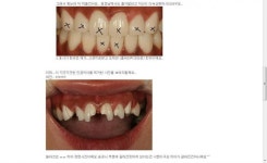 치아 시술중 라미네이트에 대한 것.jpg - 뽐뿌:자유게시판 치아 시술중 라미네이트에 대한 것.jpg