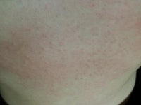 명현현상...이 존재할까요?? - 뽐뿌:메디컬포럼 명현현상...이 존재할까요??