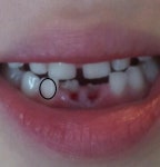 유치(젖니) 뺐는데 사진으로 봤을때 영구치 공간이 적당한가요?? - 뽐뿌:육아포럼 유치(젖니) 뺐는데 사진으로 봤을때 영구치 공간이 적당한가요??