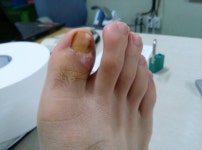 (혐오짤 주의)내성발톱 수술한지 두달짼데 안낫네요 - 뽐뿌:메디컬포럼 (혐오짤 주의)내성발톱 수술한지 두달짼데 안낫네요