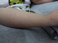 아이 피부좀 봐주세요어떤 피부질환인지 아시는분 계신가요?? - 뽐뿌:육아포럼 아이 피부좀 봐주세요어떤 피부질환인지 아시는분 계신가요??