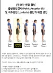 골반전방경사 및 오리궁뎅이? 얼른 오세요! 얼른! - 뽐뿌:건강/헬스 골반전방경사 및 오리궁뎅이? 얼른 오세요! 얼른!