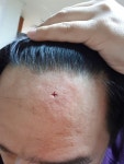 이마에 드라이버비트에 세게 박았더니.. - 뽐뿌:자유게시판 이마에 드라이버비트에 세게 박았더니..