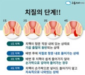 치질 수술 해보신분? 치질의 몇 단계에서? - 뽐뿌:자유게시판 치질 수술 해보신분? 치질의 몇 단계에서?
