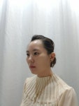 여성//헤어라인교정//절개모발이식//2500모//6개월후기 - 뽐뿌:메디컬뽐뿌 여성//헤어라인교정//절개모발이식//2500모//6개월후기