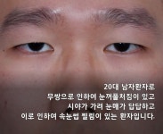 3개월만에 대박난 남자 눈 성형 전 후..JPG - 뽐뿌:자유게시판 3개월만에 대박난 남자 눈 성형 전 후..JPG