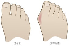 엄지발가락 바깥으로 휘는 이 질환…여성에게 더 많아 - 뽐뿌:사회/문화뉴스 엄지발가락 바깥으로 휘는 이 질환…여성에게 더 많아