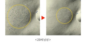 주식회사 니들워커 | Y자모공 꽉 쪼여요 360º회전니들 MTS크림 by 주식회사 어댑트 | wadiz 모공에 쏘는 40만니들샷! Y자모공 꽉 쪼여요 360º회전니들 MTS크림...