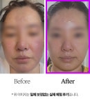 1억 원료 EGF 최대 함량 | 피부의 불로불사는 기필코 막을수 있어요!