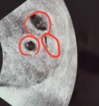 세쌍둥이 만삭에 퉁퉁 부은 발 공개한 황신영… 너무나 눈물 난다 | 위키트리 세쌍둥이 만삭에 퉁퉁 부은 발 공개한 황신영… 너무나 눈물 난다