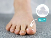 하루 30분으로 내성 발톱 고통 없이 빠르게 교정하는 법 | 위키트리 하루 30분으로 내성 발톱 고통 없이 빠르게 교정하는 법
