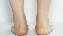 보기 싫은 발뒤꿈치 각질... 매끈하게 뒤바꾸는 가장 빠른 방법 | 위키트리 보기 싫은 발뒤꿈치 각질... 매끈하게 뒤바꾸는 가장 빠른 방법