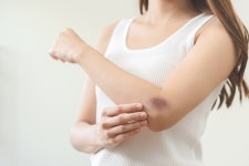 최근 몸에 모르는 멍 자국이 늘었다면…최근에 한 이 행동을 돌아봐야 | 위키트리 최근 몸에 모르는 멍 자국이 늘었다면…최근에 한 이 행동을... 