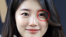 “그냥 두면 악성 종양…” 수지, 수술 받았다 | 위키트리 “그냥 두면 악성 종양…” 수지, 수술 받았다 