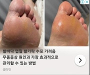꼳휴 가려운데 왜 이러지??.. 사타구니 습진약 발랐는 데 - 자유게시판 - 코인판