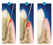 잇몸치료 나눠서 하는 이유? 잇몸치료 통증, 실비가능 여부까지! - 닥터나우 잇몸치료 나눠서 하는 이유? 잇몸치료 통증, 실비가능 여부까지!
