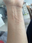 블라인드 | 블라블라: 풀독인가?ㅠ 블라블라: 풀독인가?ㅠ