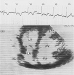 [PDF] Gene for arrhythmogenic right ventricular cardiomyopathy with diffuse nonepidermolytic palmoplantar keratoderma and woolly... 