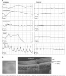 [PDF] Autosomal recessive cone-rod dystrophy can be caused by mutations in the ATF6 gene | Semantic Scholar