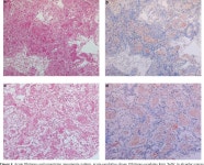 [PDF] Pulmonary pathology of severe acute respiratory syndrome in Toronto | Semantic Scholar