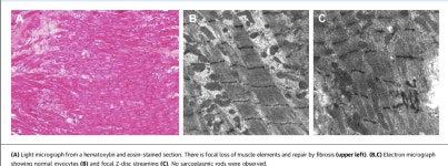 A Middle-Aged Man Presenting With Progressive Heart Failure, Myopathy, and Monoclonal Gammopathy of Uncertain Significance... 