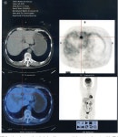 [PDF] Surgical resection of vasoactive intestinal peptideoma with hepatic metastasis aids symptom palliation: A case report... 