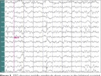[PDF] A case of congenital Rett variant in a Chinese patient caused by a FOXG1 mutation | Semantic Scholar