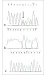[PDF] A case of congenital Rett variant in a Chinese patient caused by a FOXG1 mutation | Semantic Scholar