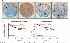 [PDF] Endoglin expression in breast tumor cells suppresses invasion and metastasis and correlates with improved clinical outcome... 