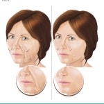 [PDF] Facial Rejuvenation Enhancing Cheek Lift | Semantic Scholar