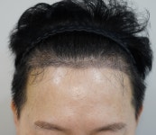 [바람부는날에도성형외과의원] 너무나 친절하고 상세한 시술 과정에 만족스럽습니다. | 모발이식 후기,리뷰,비용은 대다모!