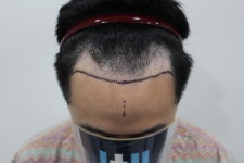 [모재성] 모재성 수술 1년차 후기 | 모발이식 후기,리뷰,비용은 대다모!