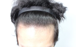 [Fuck탈모] ★ 남성형 탈모에 대한 개인적인 고찰 ★ Fuck탈모 ★ 남성형 탈모에 대한 개인적인 고찰 ★