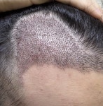 [re] 질문이요:D | 모발이식 후기,리뷰,비용은 대다모!