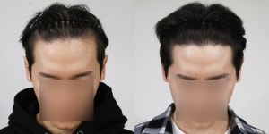 [모플러스성형외과] 모플러스 비절개 1700모 1년 후기 | 모발이식 후기,리뷰,비용은 대다모!