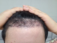 미용성형외과학3 서적 발간, 모제림 황정욱원장님 모발이식 분야 집필 참여 미용성형외과학3 서적 발간 모제림 황정욱원장님 모발이식 분야... 