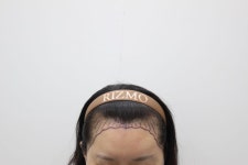 901모낭 비절개이식수술 했습니다 | 모발이식 후기,리뷰,비용은 대다모!