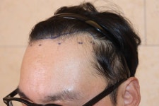 어머니 두피문신 사진입니다 대한민국 1등 탈모 커뮤니티 대다모
