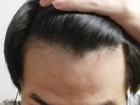 [23세탈모] 프페에서 아보로 갈아타야되나 6개월비교 | 대한민국 1등 탈모 커뮤니티 대다모