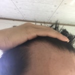 [22세탈모] 군대 일주일 앞둔 22살인데 나 탈모 빼박이지 원형이랑 m자 | 대한민국 1등 탈모 커뮤니티 대다모
