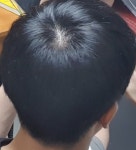 [학교생활] 뒤통수에서 정수리가 보임 | 대한민국 1등 탈모 커뮤니티 대다모